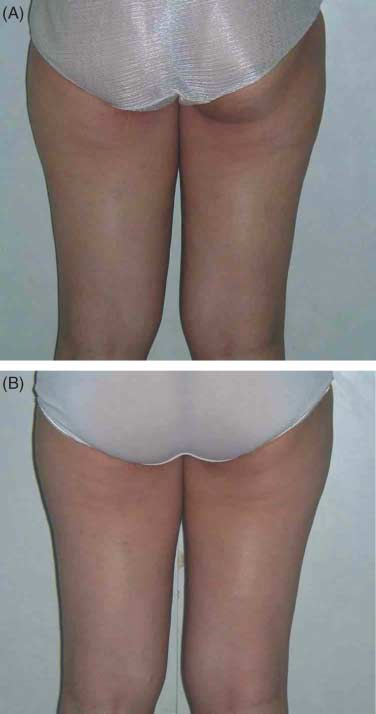 Improvement of cellulite using radiofrequency heating treatment.