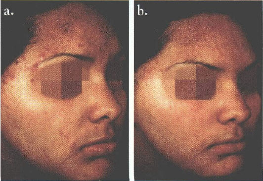 Before and after treatment of acne by a photopneumatic device.