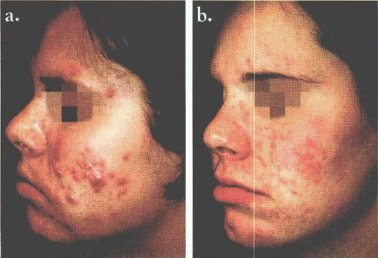 Before and after treatment of acne by a photopneumatic device.