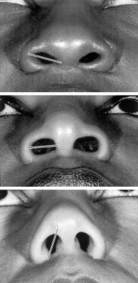 Nostril shapes in African-American women