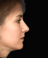 Average nose profile in a sample of 12 white women.