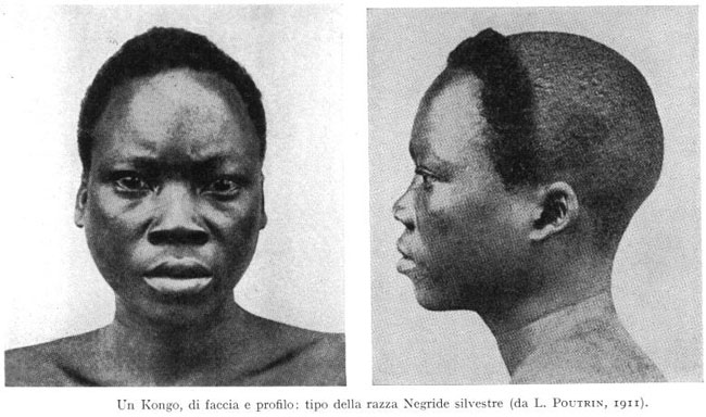 Flattened nasal bones in a Congolese.
